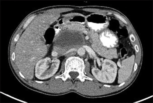 EUS-guided through-the-needle microforceps biopsy for diagnosis of tubercular lymphadenitis mimicking pancreatic cystic lesion (with video).