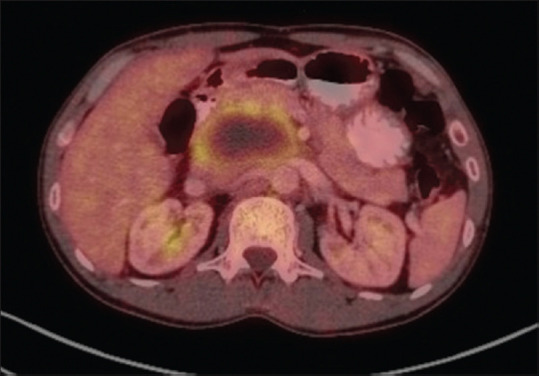 EUS-guided through-the-needle microforceps biopsy for diagnosis of tubercular lymphadenitis mimicking pancreatic cystic lesion (with video).