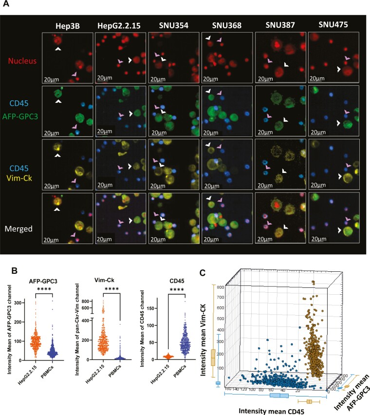 Lytic efficiency of immunosuppressive drug-resistant armoured T cells against circulating HBV-related HCC in whole blood.