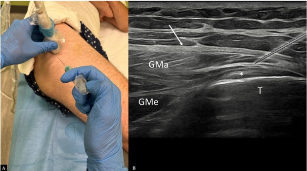 Ultrasound-guided Musculoskeletal Interventional Procedures Around the Hip: A Practical Guide.