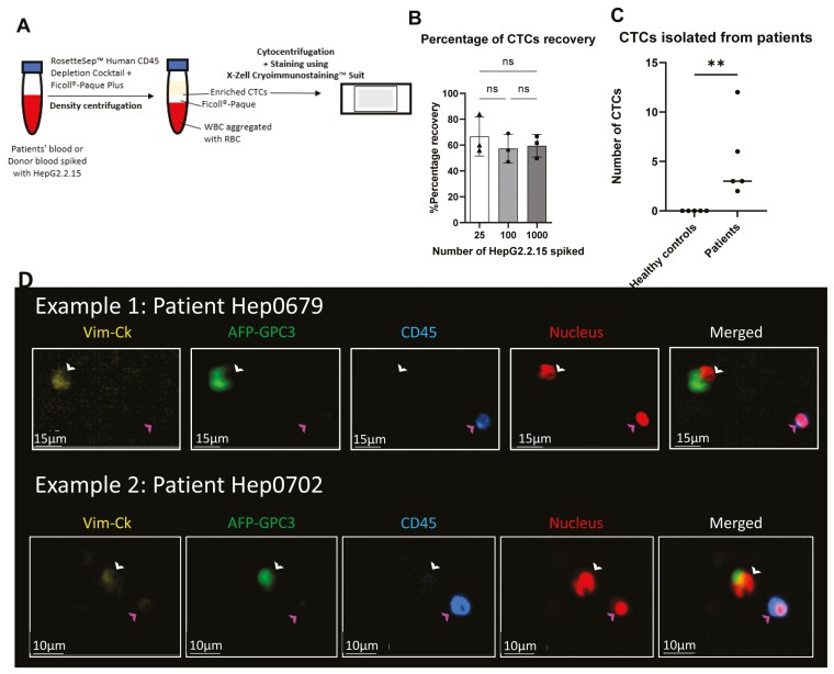 Lytic efficiency of immunosuppressive drug-resistant armoured T cells against circulating HBV-related HCC in whole blood.