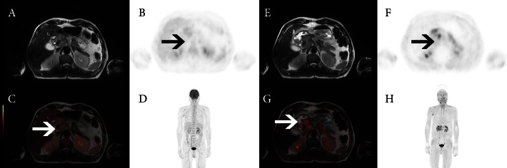 Comparison of [<sup>68</sup>Ga]Ga-DOTA-FAPI-04 and [<sup>18</sup>F]FDG PET/MRI in the Preoperative Diagnosis of Gastric Cancer.