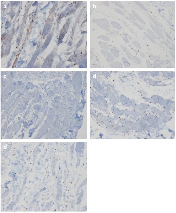 Histopathological View of Benign Essential Blepharospasm: Orbicularis Oculi Hormone Receptor Levels.