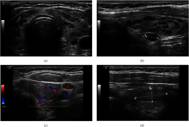 Hashimoto Thyroiditis beyond Cytology: A Correlation between Cytological, Hormonal, Serological, and Radiological Findings.