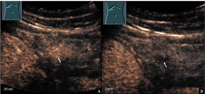 Inflammatory Pseudotumor of the Omentum in Contrast-enhanced Ultrasound.