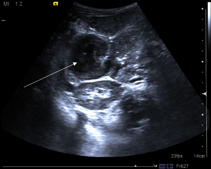 Intussusception in a 4-Year-Old Male Due to Burkitt Lymphoma.