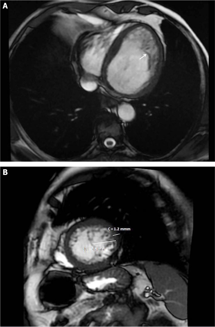 Experience of 500 cardiovascular magnetic resonance imaging and systematic analysis of cases.