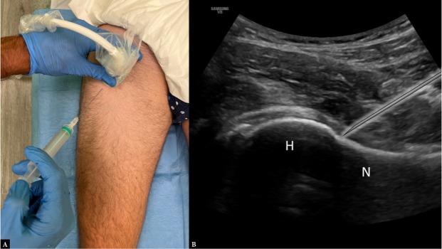 Ultrasound-guided Musculoskeletal Interventional Procedures Around the Hip: A Practical Guide.