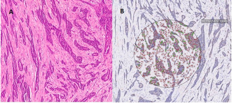 MCM-2 Levels as a Potential Biomarker for Predicting High-Risk Breast Cancer Patients According to TAILORx Classification.