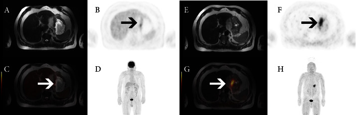 Comparison of [<sup>68</sup>Ga]Ga-DOTA-FAPI-04 and [<sup>18</sup>F]FDG PET/MRI in the Preoperative Diagnosis of Gastric Cancer.