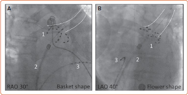 Pulsed Field Ablation for Atrial Fibrillation.