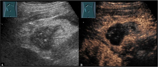 Inflammatory Pseudotumor of the Omentum in Contrast-enhanced Ultrasound.