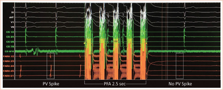 Pulsed Field Ablation for Atrial Fibrillation.