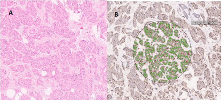 MCM-2 Levels as a Potential Biomarker for Predicting High-Risk Breast Cancer Patients According to TAILORx Classification.