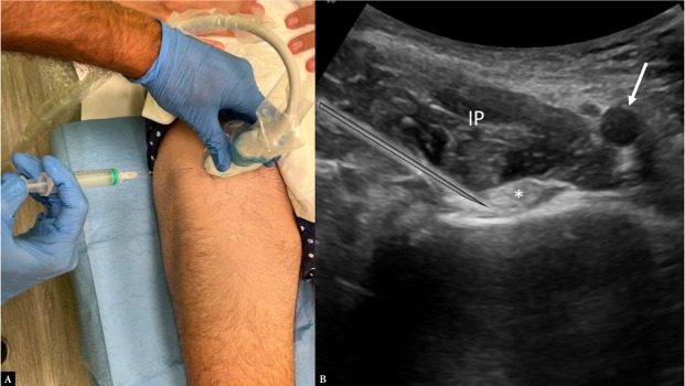 Ultrasound-guided Musculoskeletal Interventional Procedures Around the Hip: A Practical Guide.