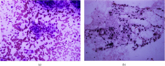 Hashimoto Thyroiditis beyond Cytology: A Correlation between Cytological, Hormonal, Serological, and Radiological Findings.