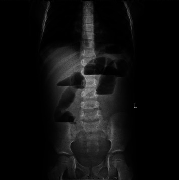 Intussusception in a 4-Year-Old Male Due to Burkitt Lymphoma.