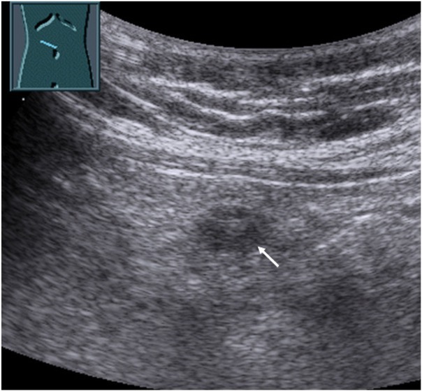 Inflammatory Pseudotumor of the Omentum in Contrast-enhanced Ultrasound.