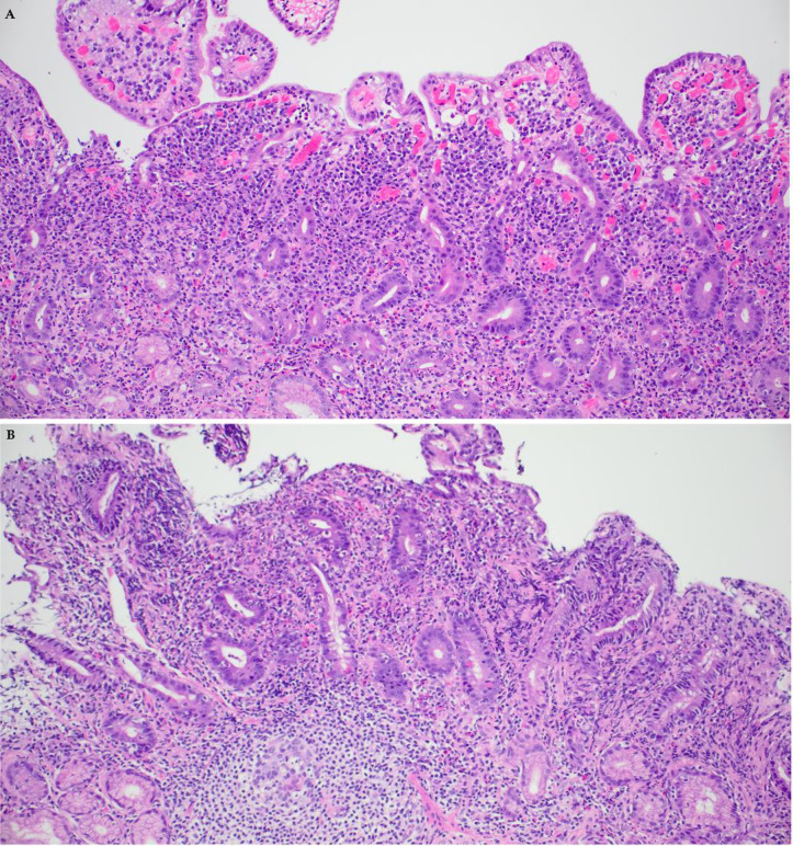 Immune checkpoint inhibitor therapy associated enteritis mimicking celiac disease.