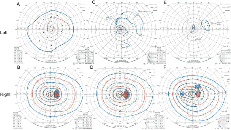 A case of papilledema in Camurati-Engelmann disease treated effectively with prednisolone.