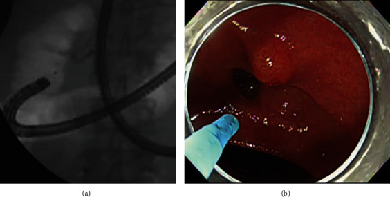 The Usefulness of the Alpha-Retroflex Position in Biliary Cannulation on Single-Balloon Enteroscopy-Assisted Endoscopic Retrograde Cholangiopancreatography in Patients with Roux-en-Y Gastrectomy: A Retrospective Study.