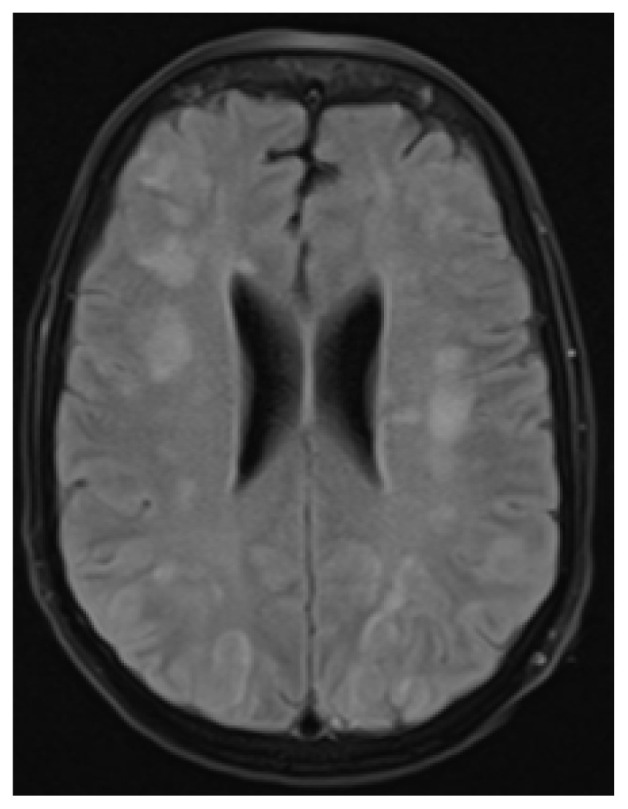 Locked-In Presentation of Guillain-Barre Syndrome Following SARS-COVID-19 Infection.