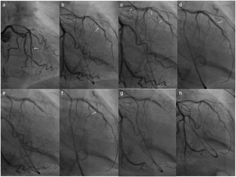 Successful Hemostasis With Prolonged Balloon Inflation at the Proximal Site of the Coronary Perforation.