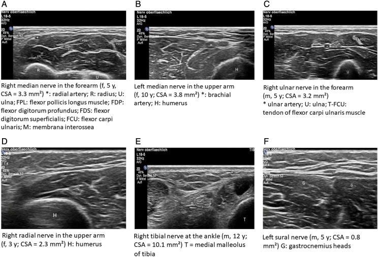 Nerve ultrasound reference values in children and adolescents: Echogenicity and influence of anthropometric factors including hand volume.