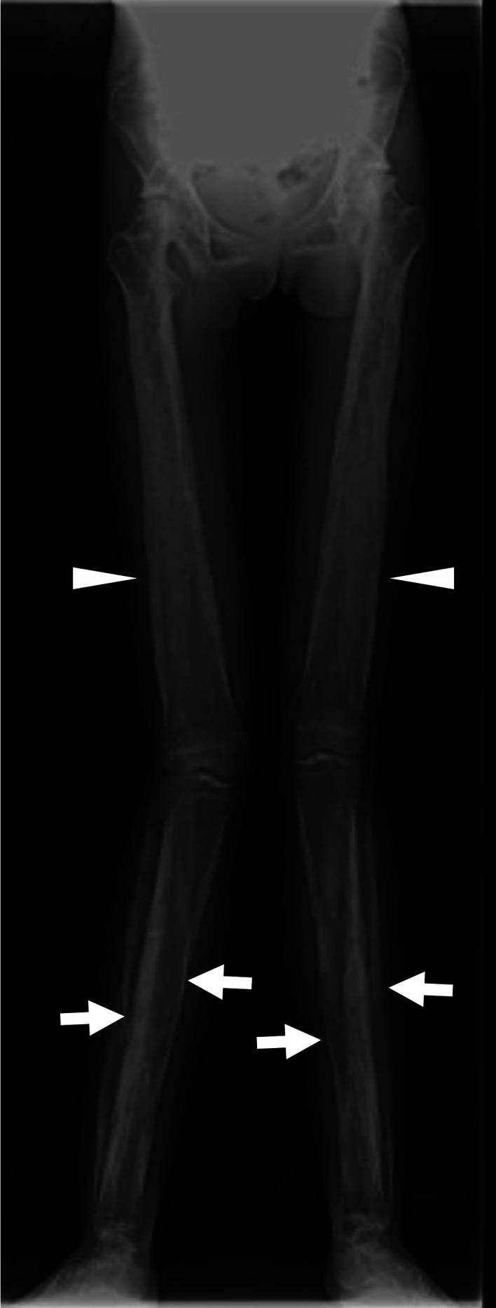 A case of papilledema in Camurati-Engelmann disease treated effectively with prednisolone.