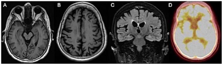 A case of familial frontotemporal dementia caused by a progranulin gene mutation