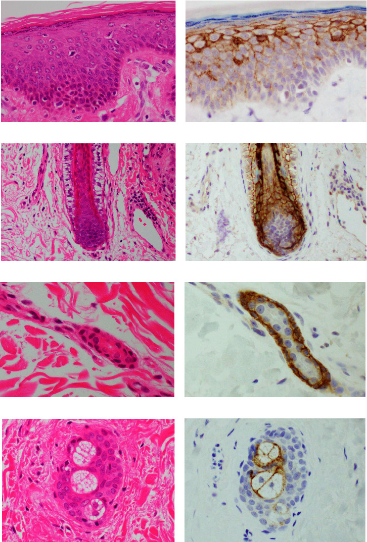 Differential Expression of Claudin 1 and 4 in Basal Cell Carcinoma of the Skin.