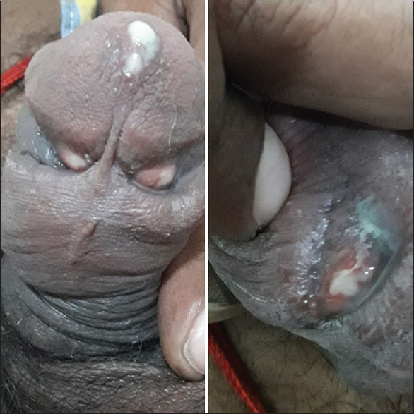 Bilateral Tyson's abscess as a complication of acute gonorrhea.