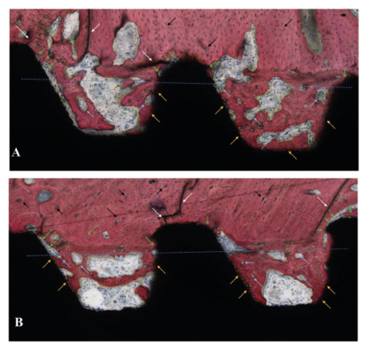 Impact of implant thread design on insertion torque and osseointegration: a preclinical model.