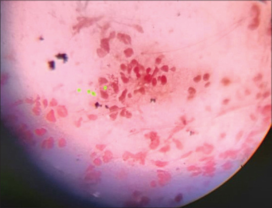 Bilateral Tyson's abscess as a complication of acute gonorrhea.