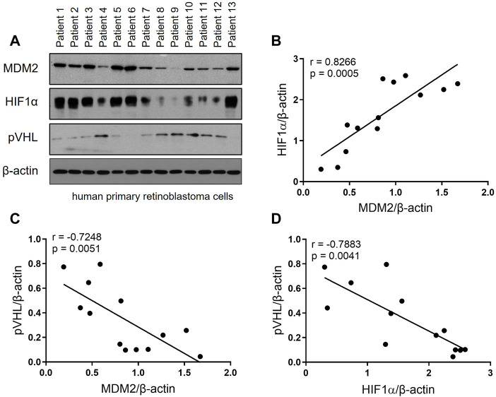 MDM2 promotes cancer cell survival through regulating the expression of HIF-1α and pVHL in retinoblastoma.