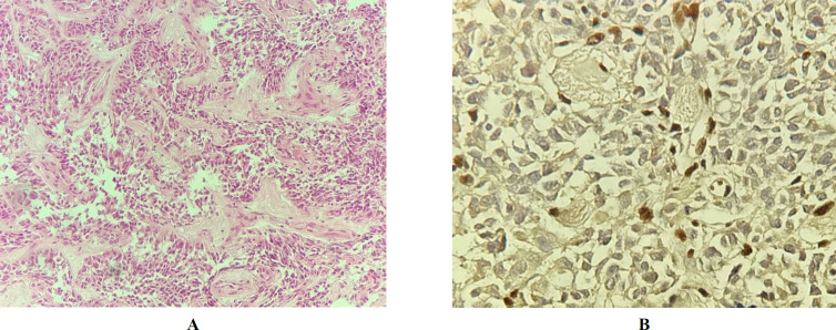 Evaluation of INI1 Protein Expression Through IHC Study in Pediatric High-Grade Brain Tumors in South of Iran in 2008-2021.