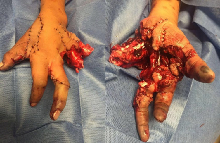 Groin Flap for Reconstruction of Traumatic Degloving Hand Injury: A Report of 5 Cases.