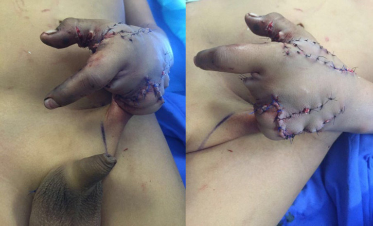 Groin Flap for Reconstruction of Traumatic Degloving Hand Injury: A Report of 5 Cases.