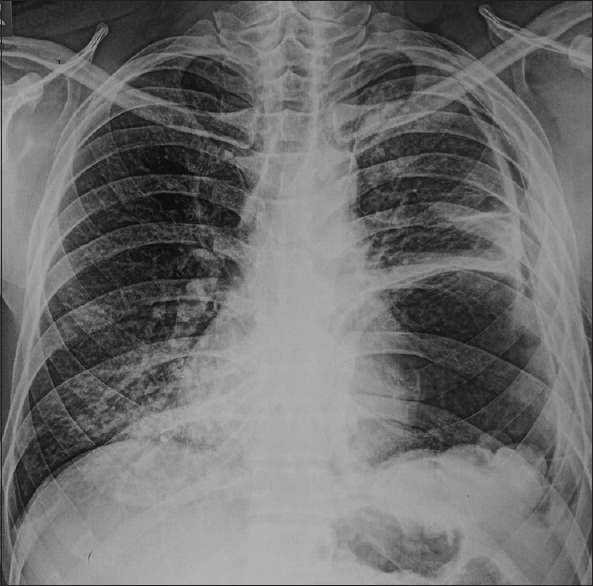 Ruptured Pulmonary Hydatid Cyst.