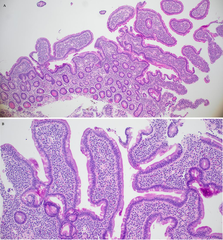 Immune checkpoint inhibitor therapy associated enteritis mimicking celiac disease.