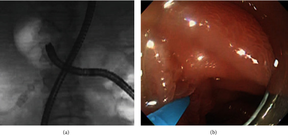 The Usefulness of the Alpha-Retroflex Position in Biliary Cannulation on Single-Balloon Enteroscopy-Assisted Endoscopic Retrograde Cholangiopancreatography in Patients with Roux-en-Y Gastrectomy: A Retrospective Study.