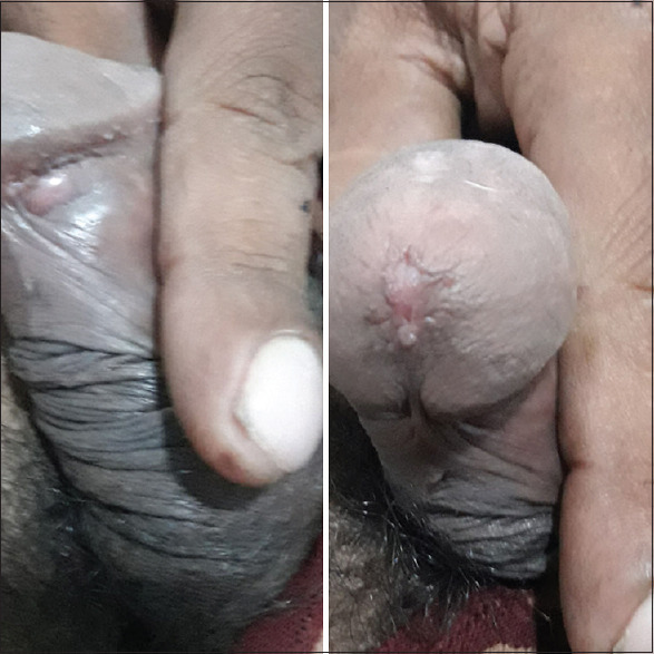 Bilateral Tyson's abscess as a complication of acute gonorrhea.