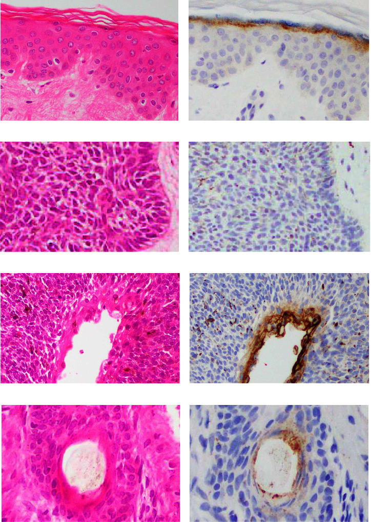 Differential Expression of Claudin 1 and 4 in Basal Cell Carcinoma of the Skin.