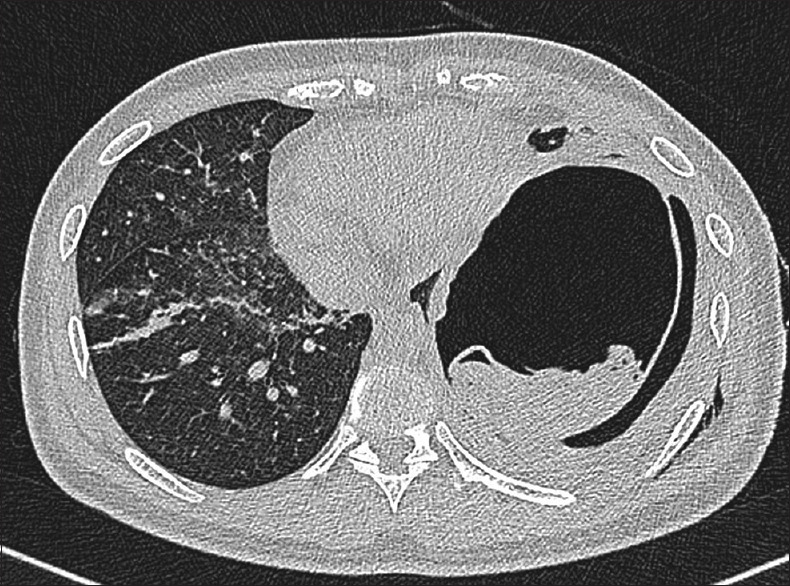 Ruptured Pulmonary Hydatid Cyst.