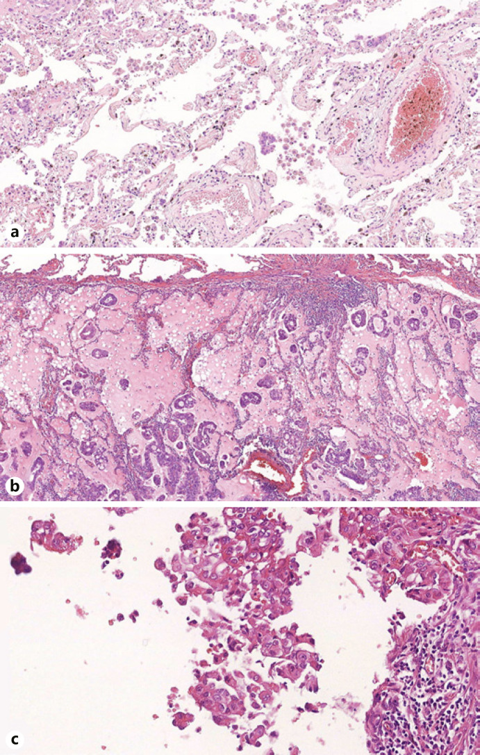 The More Extensive the Spread through Air Spaces, the Worse the Prognosis Is: Semi-Quantitative Evaluation of Spread through Air Spaces in Pulmonary Adenocarcinomas.