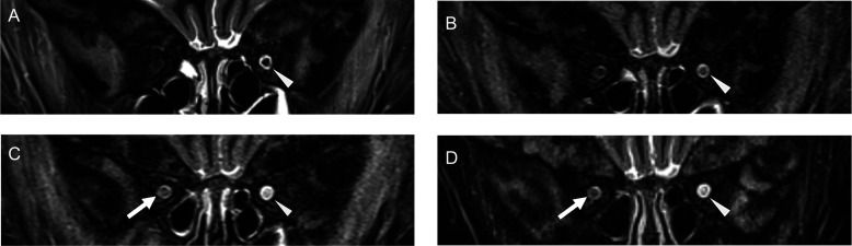 A case of papilledema in Camurati-Engelmann disease treated effectively with prednisolone.