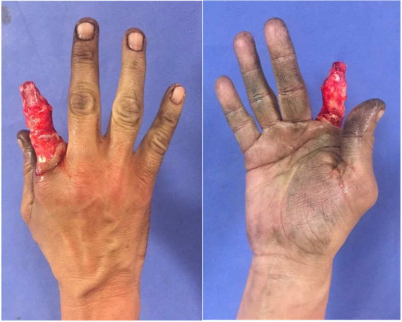 Groin Flap for Reconstruction of Traumatic Degloving Hand Injury: A Report of 5 Cases.