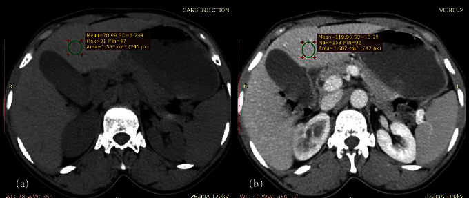 Evaluation of Iodinated Contrast Media Use in Abdominal CT Scans in Cancer Assessments: A Cross-Sectional Study in Lomé (Togo).