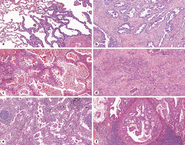 The More Extensive the Spread through Air Spaces, the Worse the Prognosis Is: Semi-Quantitative Evaluation of Spread through Air Spaces in Pulmonary Adenocarcinomas.