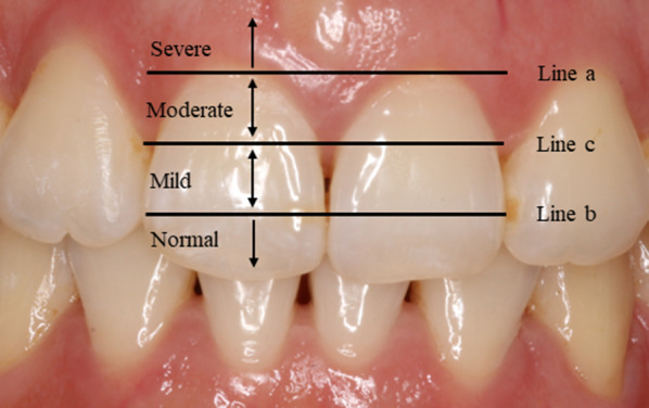 IPR treatment and attachments design in clear aligner therapy and risk of open gingival embrasures in adults.